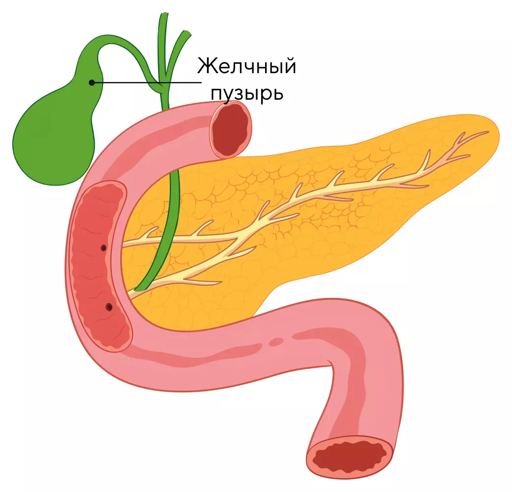 УЗИ желчного пузыря с определением функции