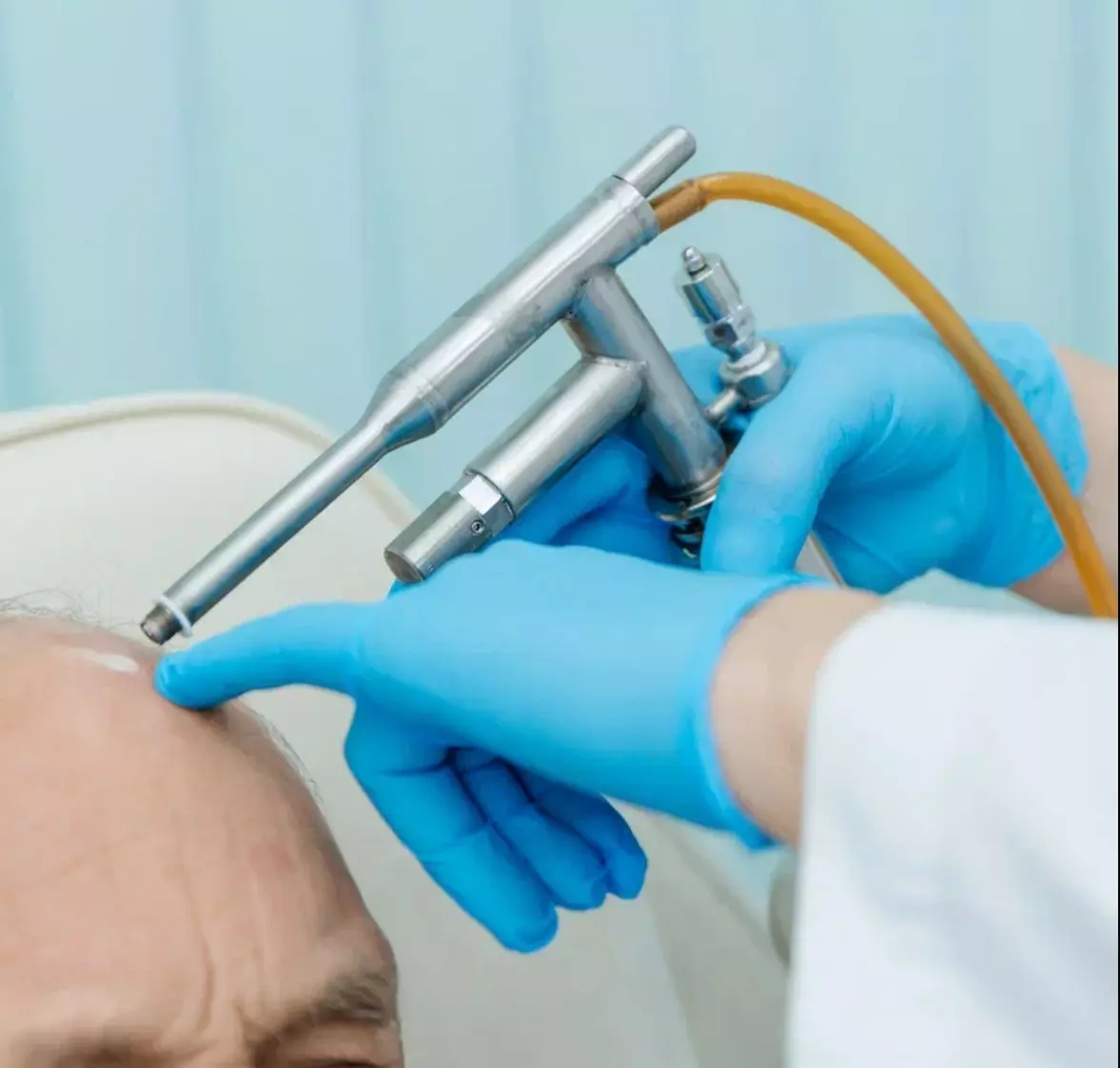 Криодеструкция новообразований: удаление бородавок и контагиозного моллюска жидким азотом