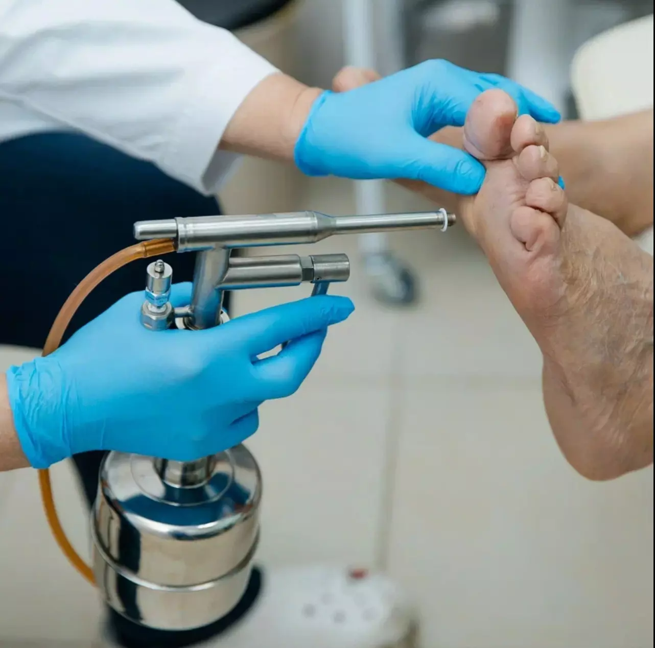 Криодеструкция новообразований: удаление бородавок и контагиозного моллюска жидким азотом