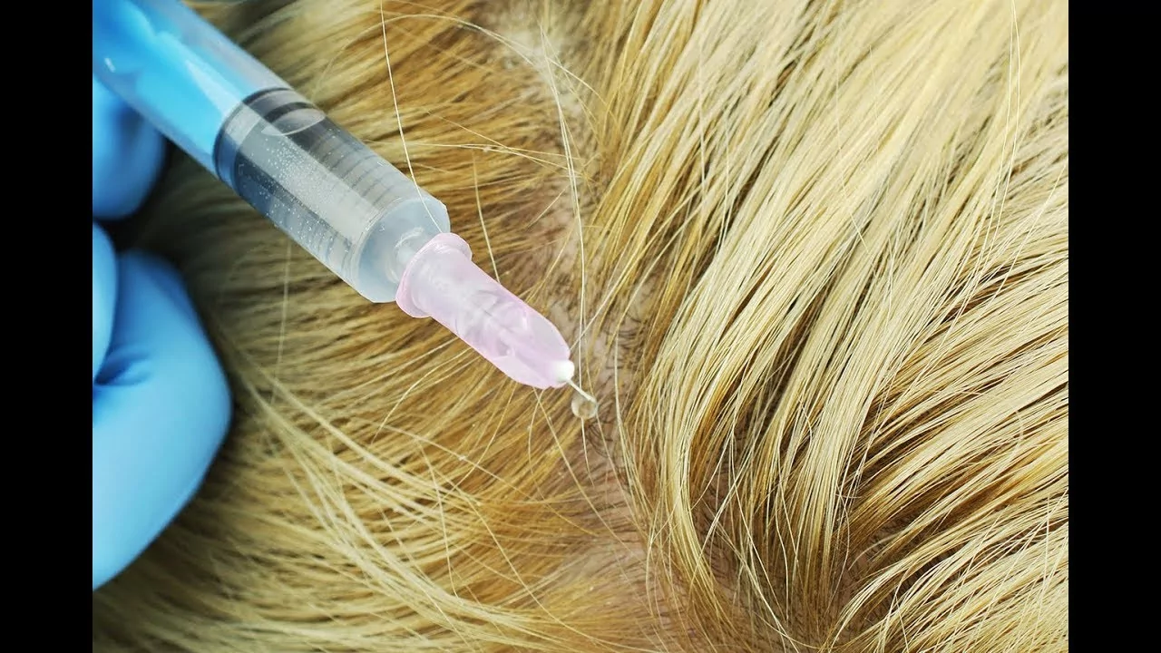 Мезотерапия волос