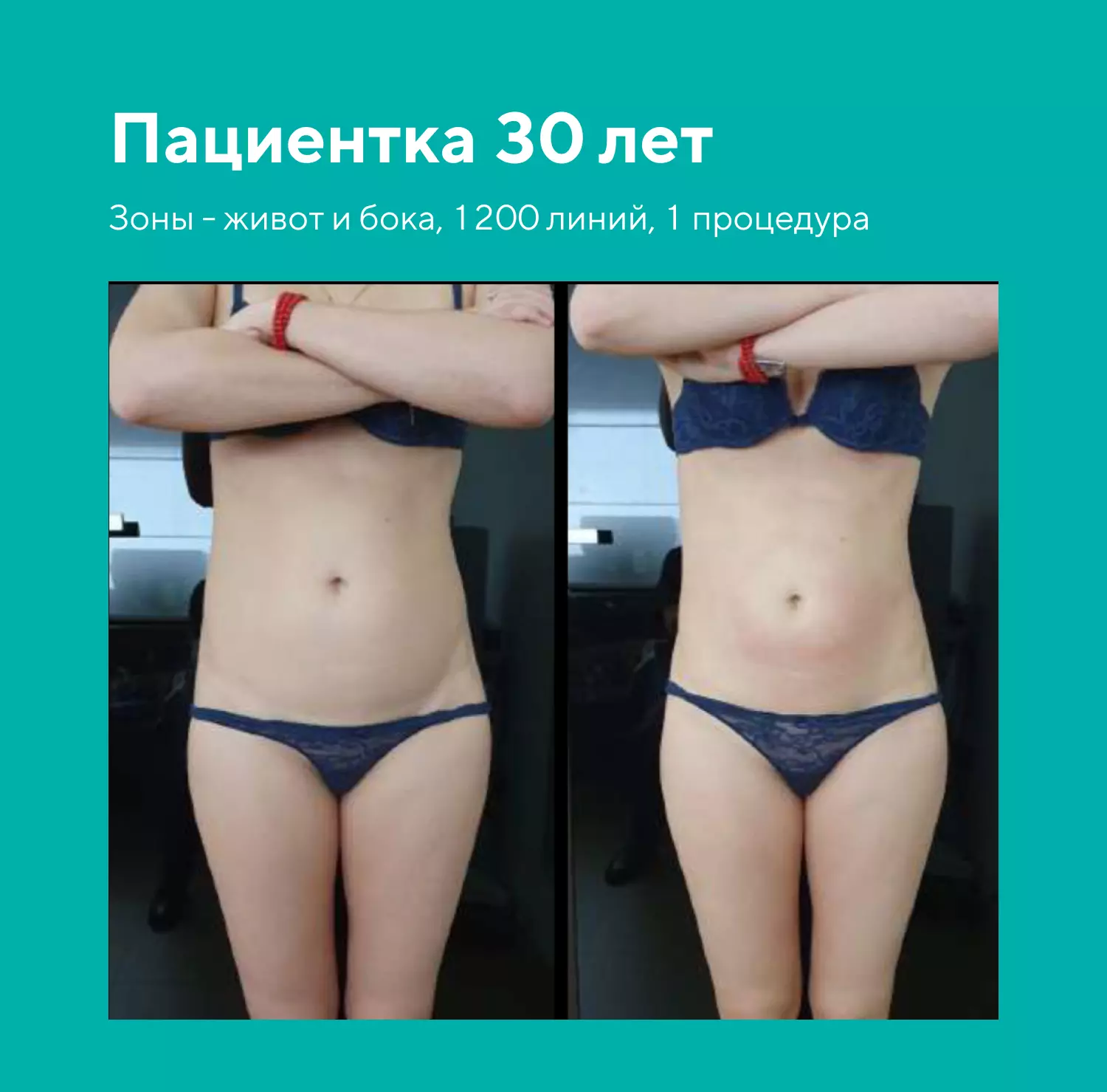 SMAS-лифтинг на аппарате Microson PT HIFU