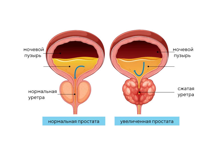 УЗИ предстательной железы