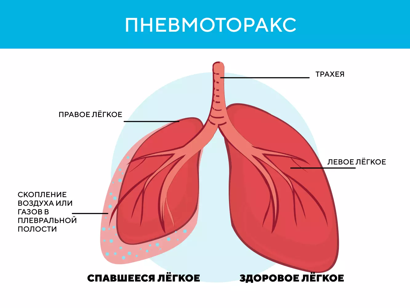 УЗИ плевральной полости