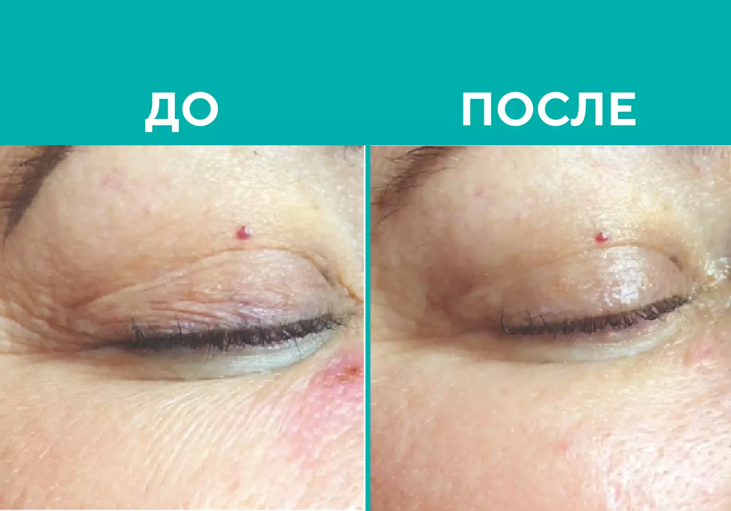 Пилинг BioRePeelCl3