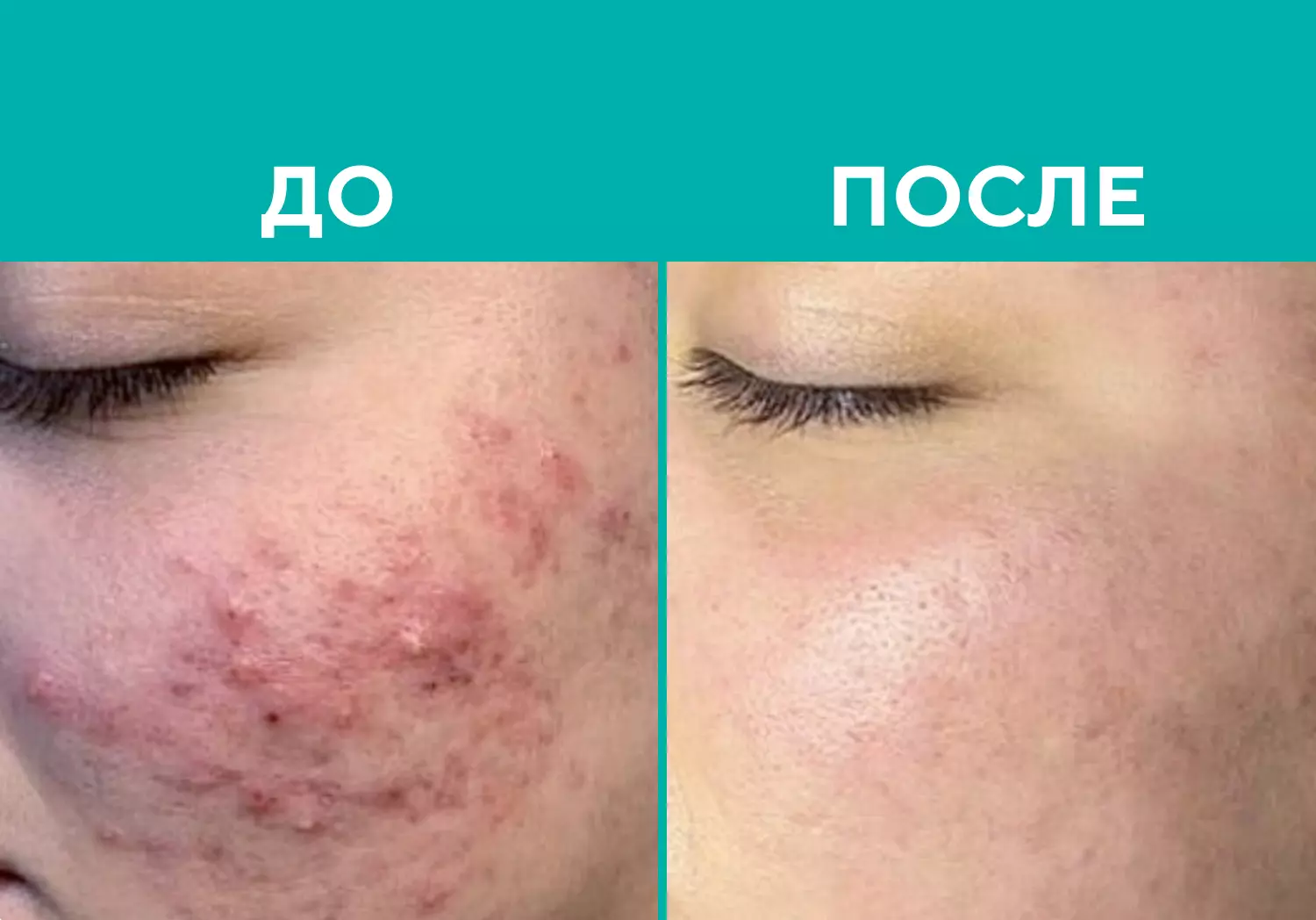 Пилинг BioRePeelCl3