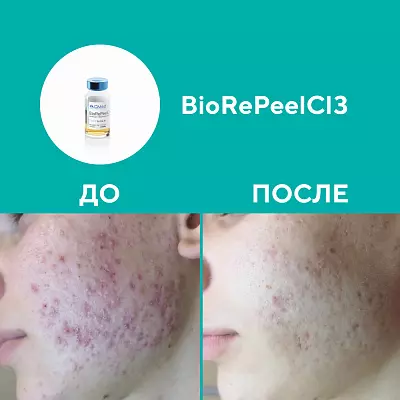 Пилинг BioRePeelCl3