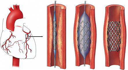 Особенности реабилитации после стентирования коронарных артерий
